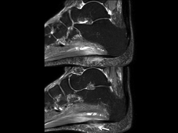 Figure 1 for case central bundle of plantar fascia ( RID3231 )